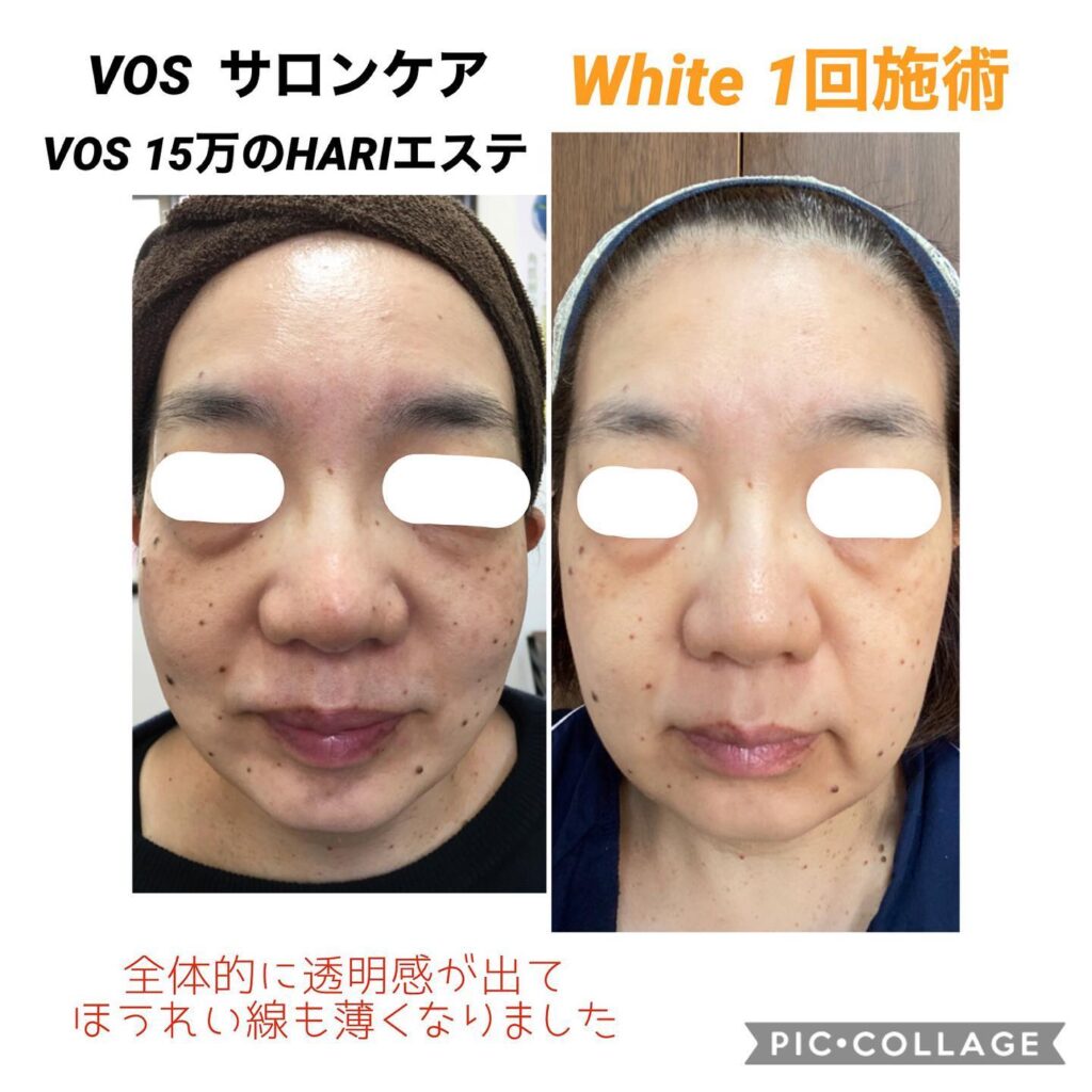 VOS ホームケアシリーズ 『ハイドラコンプレックスバイアル』 高濃度